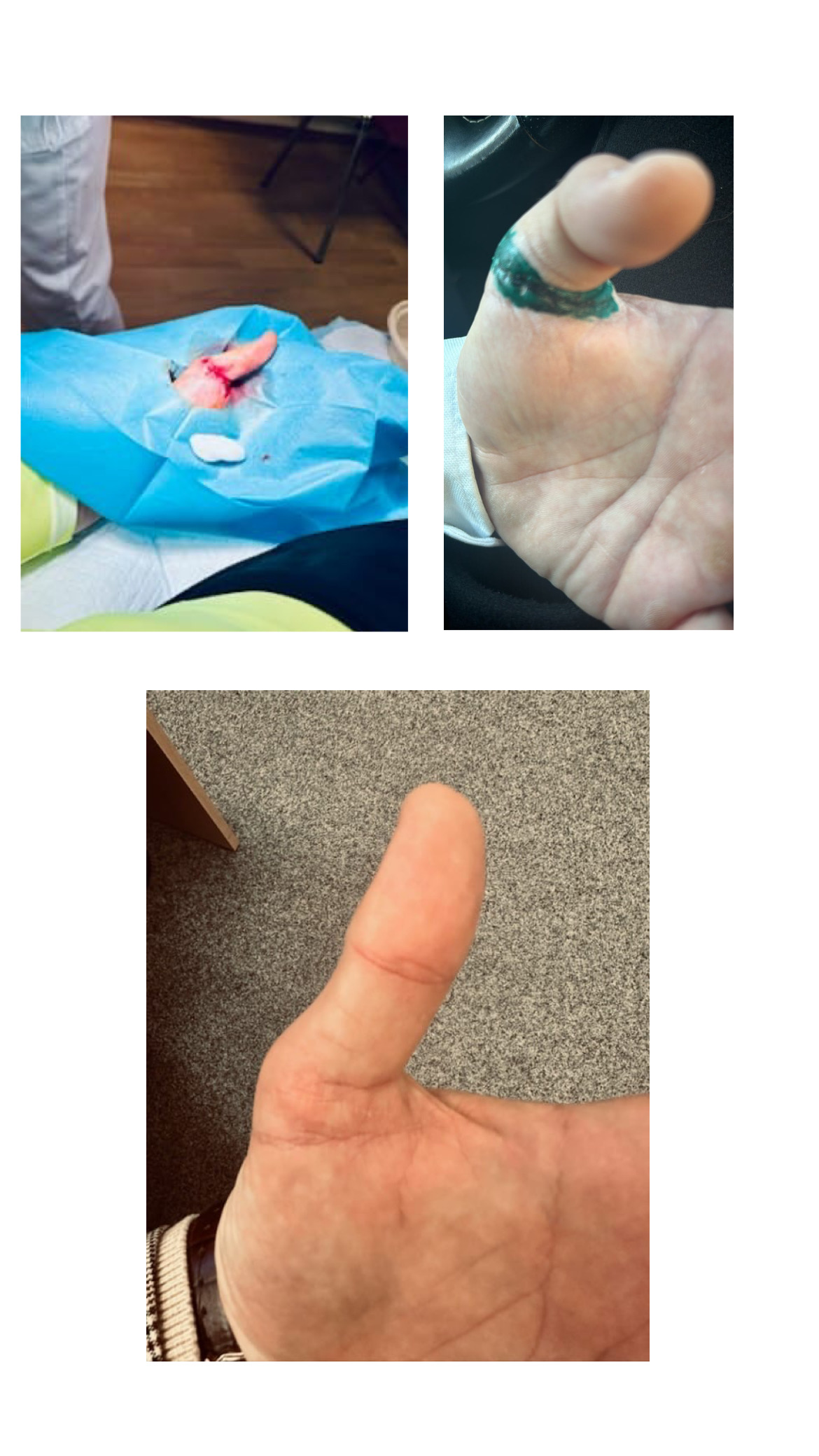 reference - lid&eacute; / Reference palec